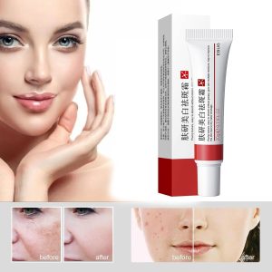 3Pcs Effective Whitening Freckle Cream,Remove Melasma Acne Cream Fading Spot Cream,Acne Scar Removal Treatment,Fade Pigmentation Anti Melasma Brighten Skin Care Creams